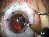 Modern Cataract Surgery: Alcon ReSTOR IOL with LRI