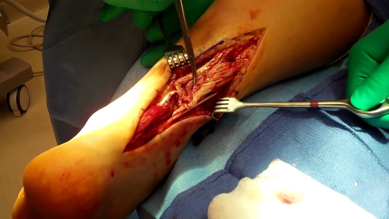 Achilles Tendon Rupture with FHL Transfer for Repair