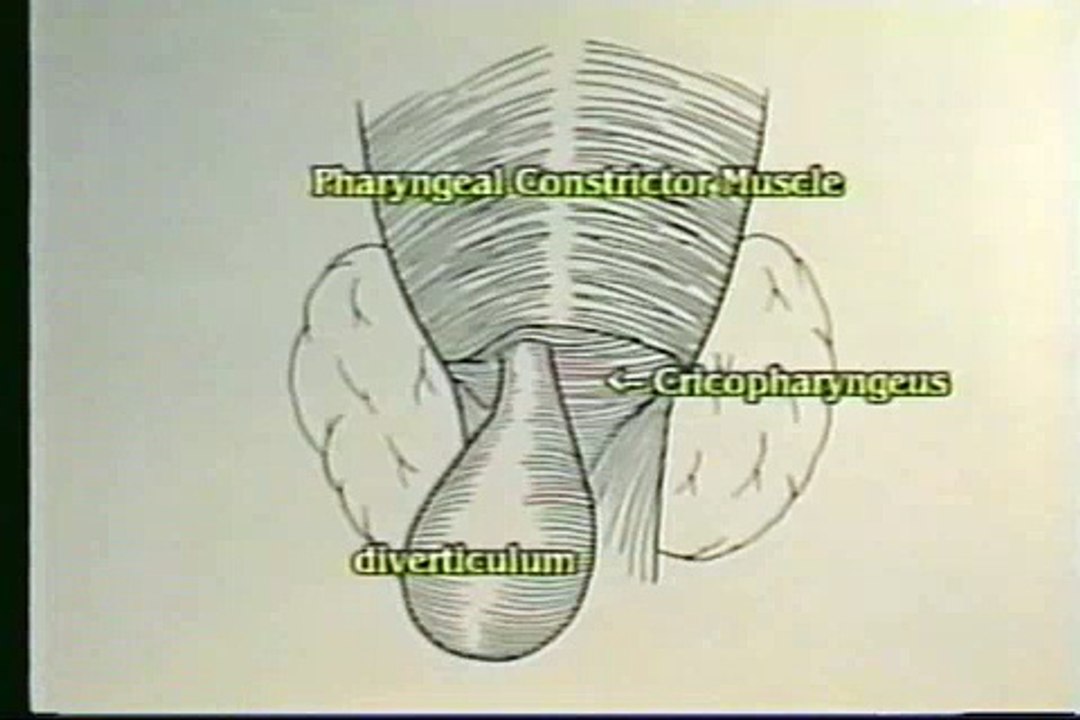 Anatomy of Zenker Diverticulum