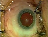 High Efficiency Cataract Surgery by Dr. Shawn Cohen, McGill University, Montreal