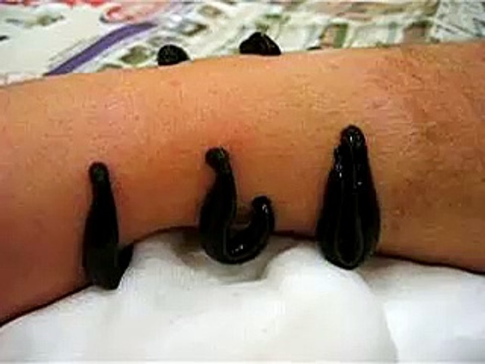 Therapy with leeches/Blutegel/bloedzuigers (Belgium) (4)