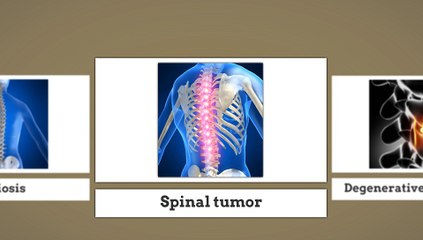 Spine Surgeon In Los Angeles For Back Ache Problems