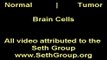 THC effects on Tumor Brain Cells, Normal Brain Cells