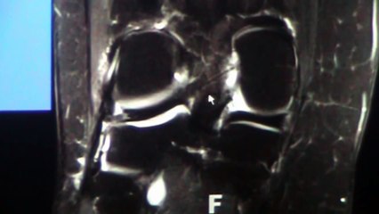 Knee MRI Part 1 for Orthopaedic and Radiology Residents
