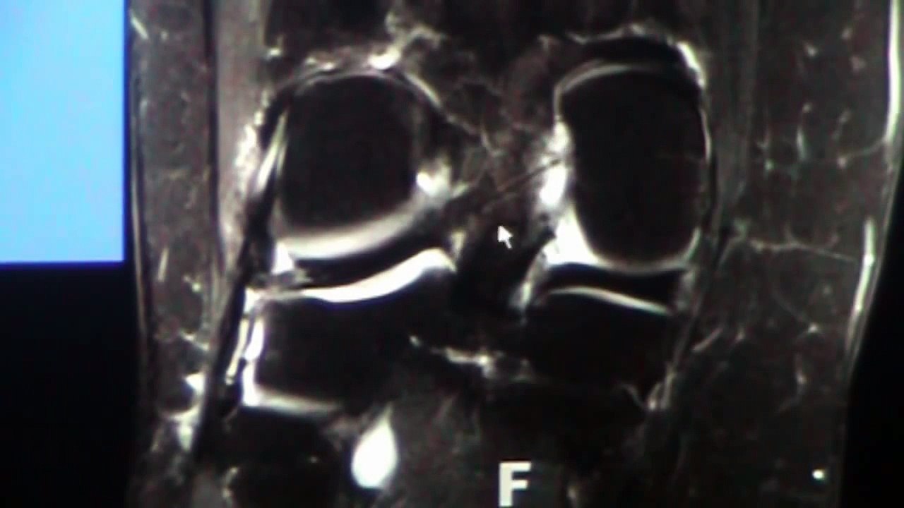 Knee MRI Part 1 for Orthopaedic and Radiology Residents