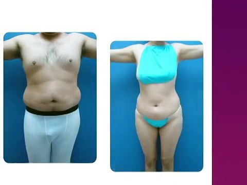 Cirugia Cosmetica, Plastica: Liposuccion e Injerto de Grasa en Gluteos