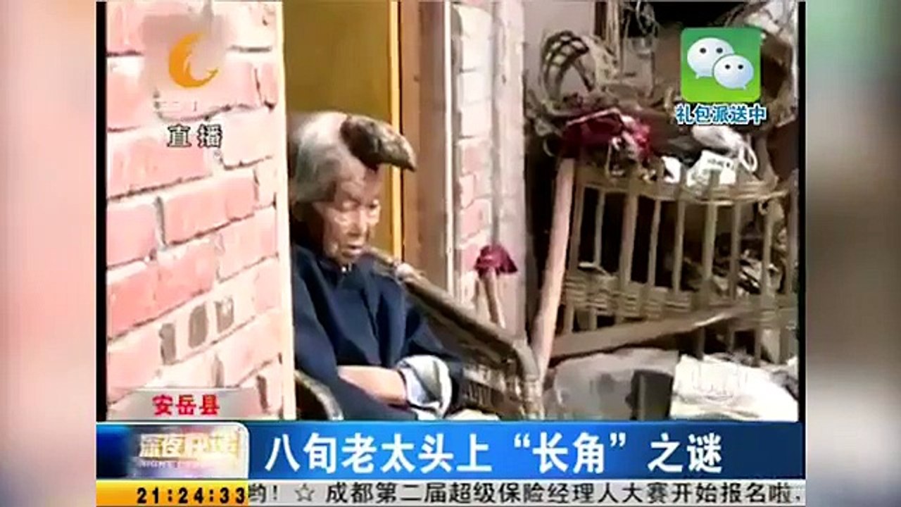 The 87-year-old woman with a HORN growing out of her head
