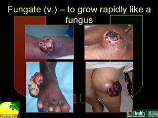 Fungating Soft Tissue Sarcomas