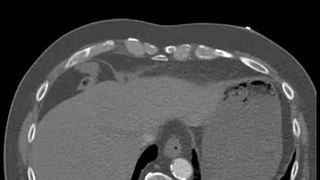 CT Ruptured Aortic Aneurysm Discussion by a Radiologist