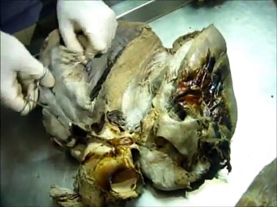 Anatomia del Corazón y Grandes Vasos. Parte 3