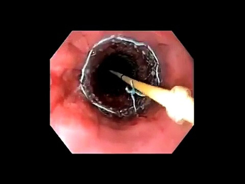 WallFlex® Partially Covered Esophageal Stent Placement - Dr. Gerke