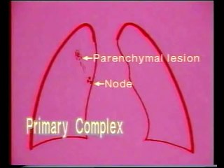 2.3. Tuberculosis Primary Complex - Chest X-Rays - Dr. Vaidya