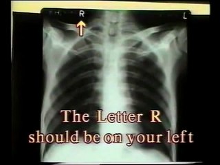 1. How to read a Chest X-Ray - Dr. Vaidya