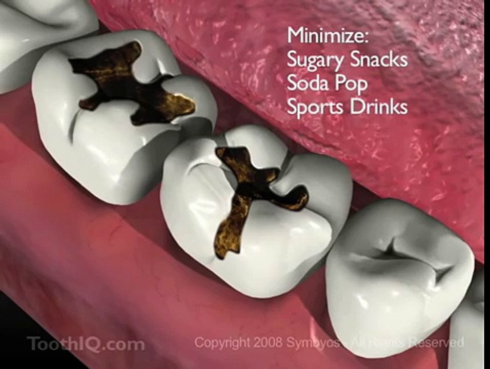 Tooth Decay (Dental Caries)