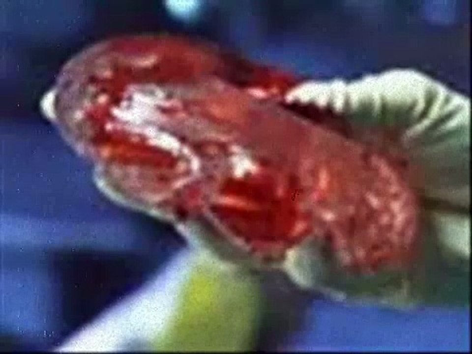 Anna Nicole Breast Implant Video(Rare)
