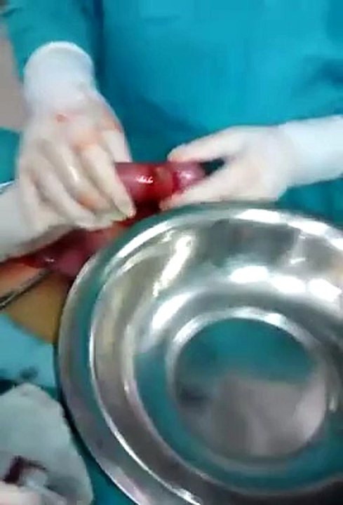 How Noodles (Spaghetti)  Can Block Your Digestive System