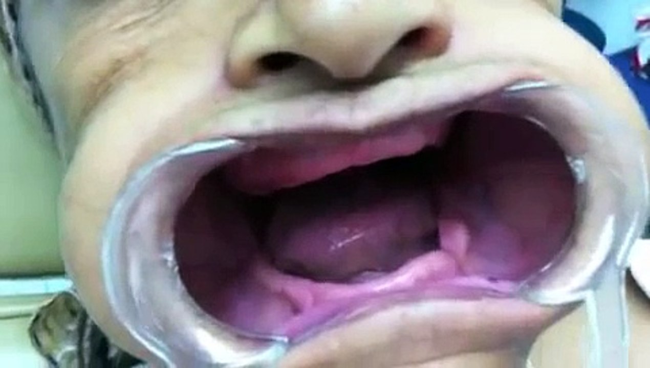 Full Denture