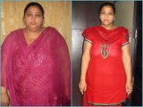 Patient lost 58 kgs after Mini Gastric Bypass | Weight Loss Surgery