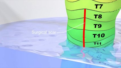 Epidural anaesthesia: how the rate of infusion and adding boluses relate to the level of the block
