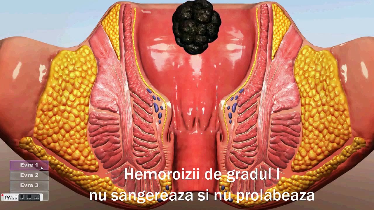 Hemoroizi interni de gradul I, II, III si IV