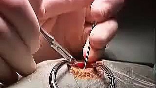 a fenestration of an arachnoid cyst  [brain surgery]