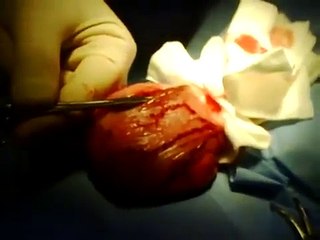 Bladder Stone Surgery Part One