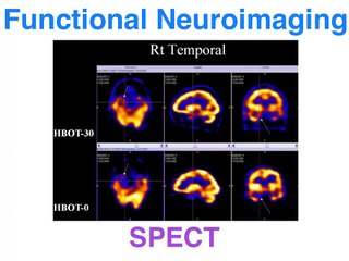 fMRI vs PET vs SPECT - functional neuroimaging