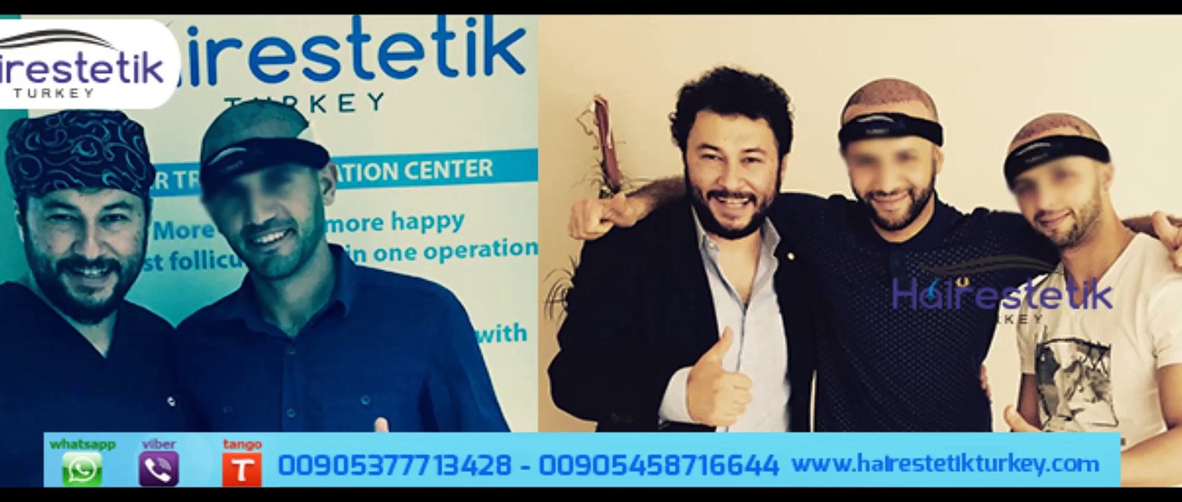 زراعة-الشعر-في-اسطنبول –  Hair Turkey- زراعة-الشعر-في-تركيا