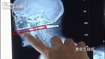 78 yo woman gets smoking pipe impaled through neck