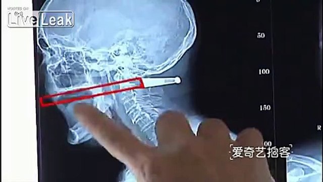78 yo woman gets smoking pipe impaled through neck
