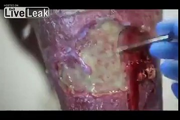 Cleaning up an infection