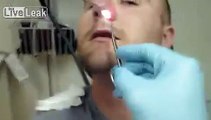 Removing Nose Splints