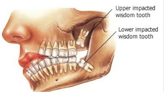 Wisdom teeth pain, infection, or decay- Why third molars are extracted?