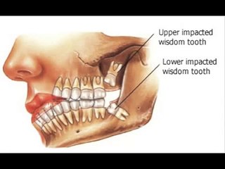 Wisdom teeth pain, infection, or decay- Why third molars are extracted?