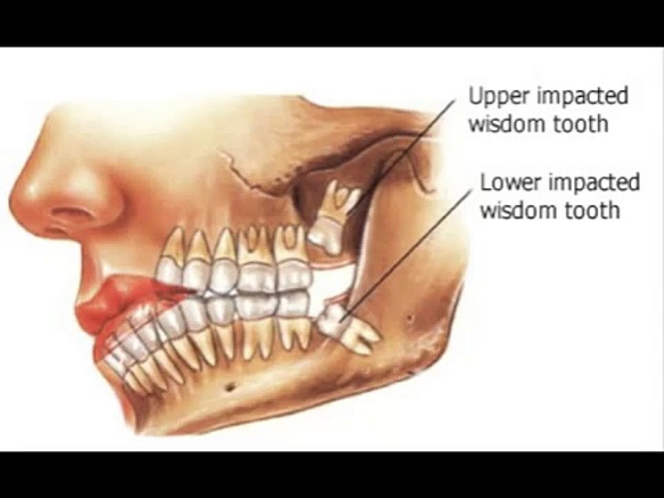 Wisdom teeth pain, infection, or decay- Why third molars are extracted?