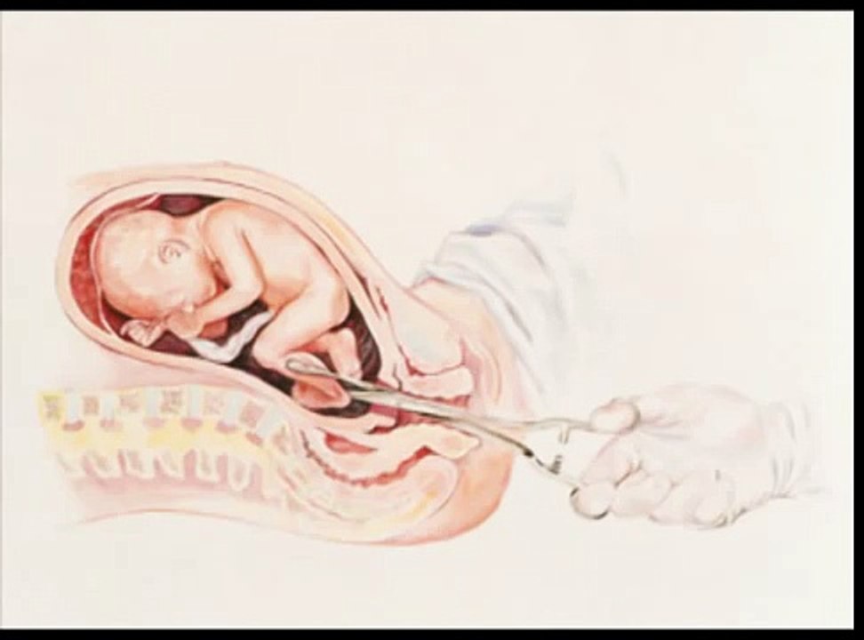 Partial-Birth Abortion Illustrated Video The Crime of Crimes / Pro-Life Anti-Abortion Film