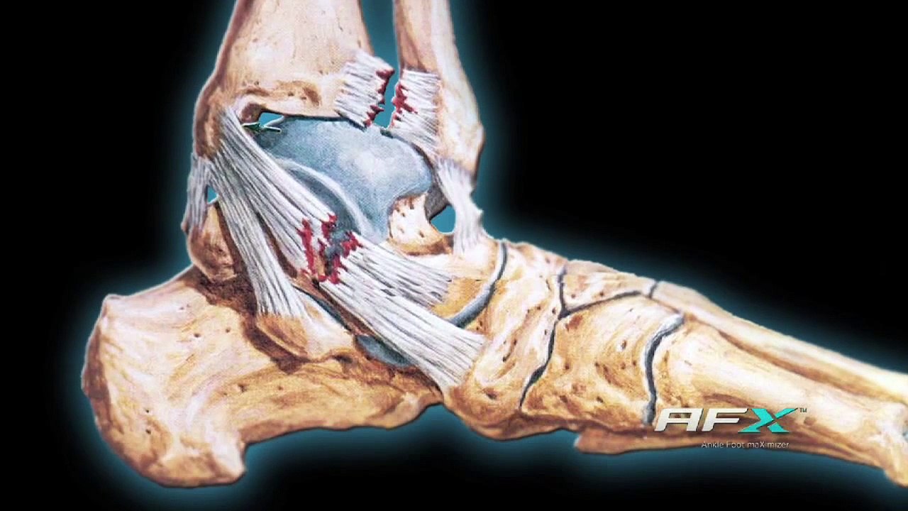 Preventing ankle sprains by strengthening your feet and ankles