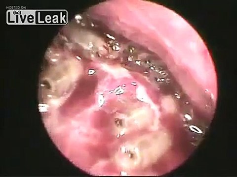 Man have nose full of white maggots