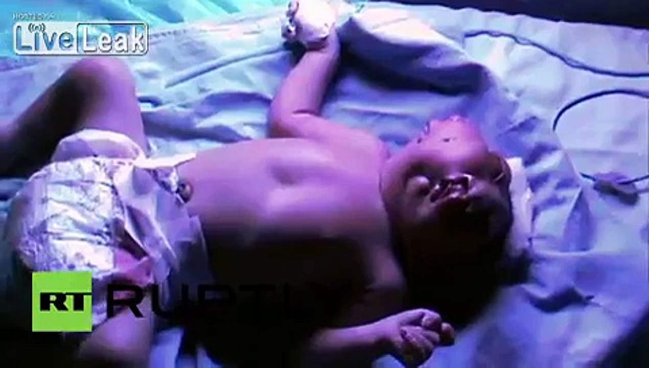 India: Baby born with two faces strives to live