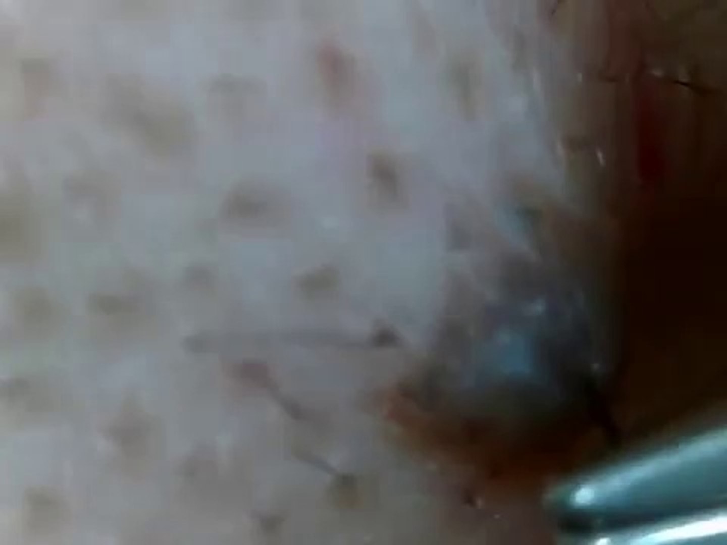 ほくろの毛を引っこ抜く Hair Of A Mole Dailymotion Video