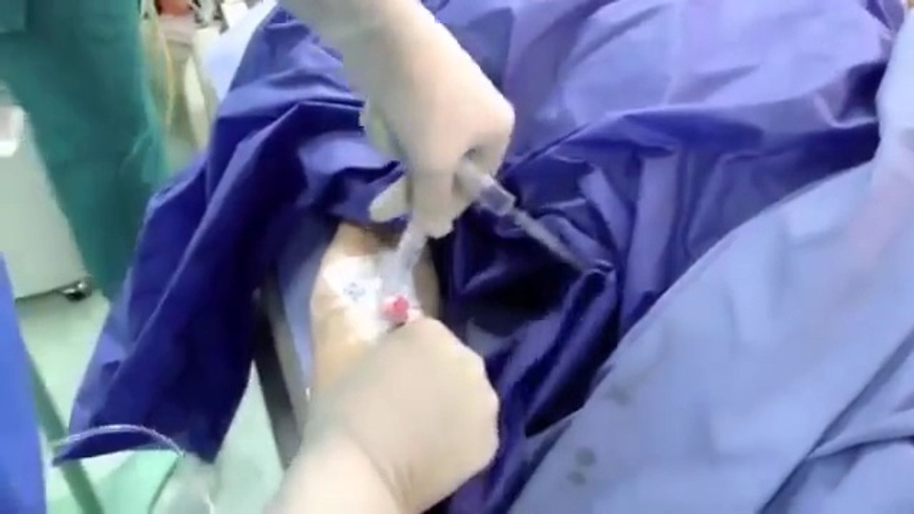 general anesthesia with endotracheal intubation