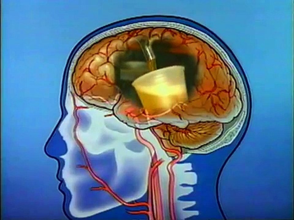 Alcohol and The brain