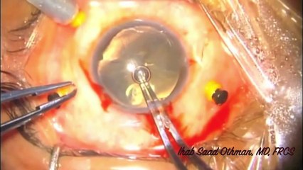 Expulsive Hemorrhage During Penetrating Keratoplasty Ihab Saad Othman