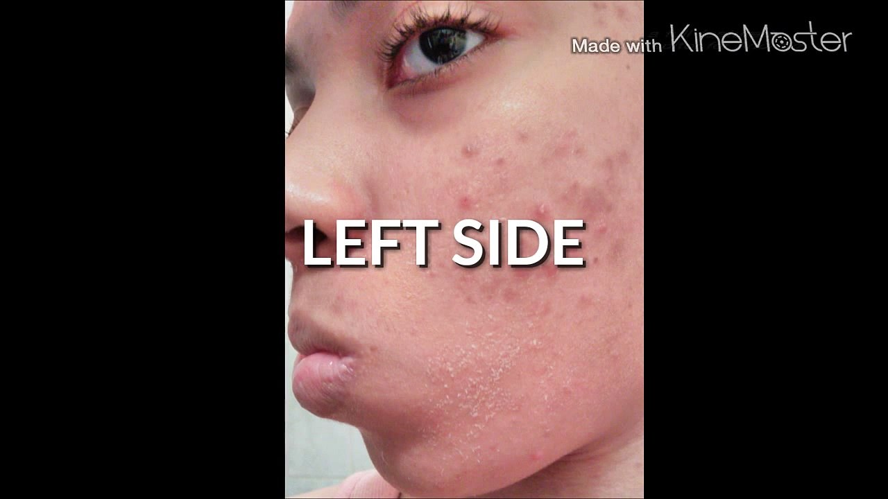 Acne Skin Care Routine (1 month of Tretinoin )