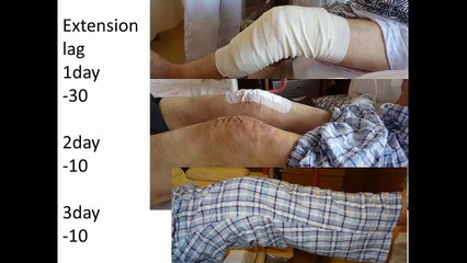 両人工膝関節手術後3日での階段昇降 (stair climbing 3 days after bilateral knee replacement)