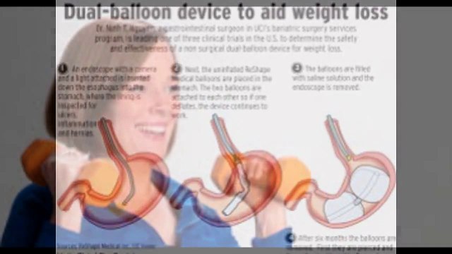 Gastric stomach ballon weight loss