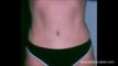 Botched:Tummy Tuck Plastic Surgery Gone Wrong fixed by Dr. Placik [Tummy Tuck]