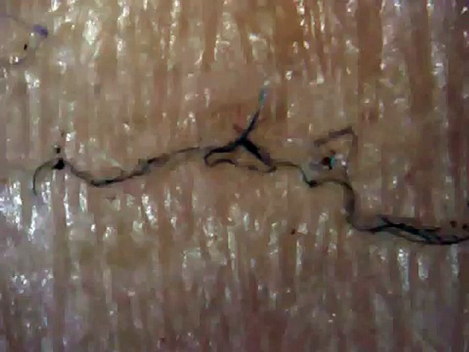 Morgellons  Bad skin day!