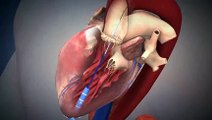 Stentklapbehandling via spidsen af hjertet (Transapicalus)