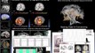 MRI Biomarkers in Alzheimer and Brain Diseases - Juan Antonio Hernandez
